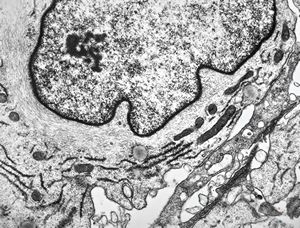 F, 49y. | myelosarcoma … histiocyte-like cells in dermal infiltrates